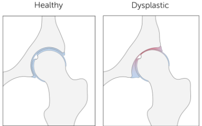 Hip Dysplasia – Taking Care